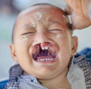 Nant Myo vor der Operation