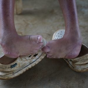 Nahaufnahme auf Gliesas Klumpfüße