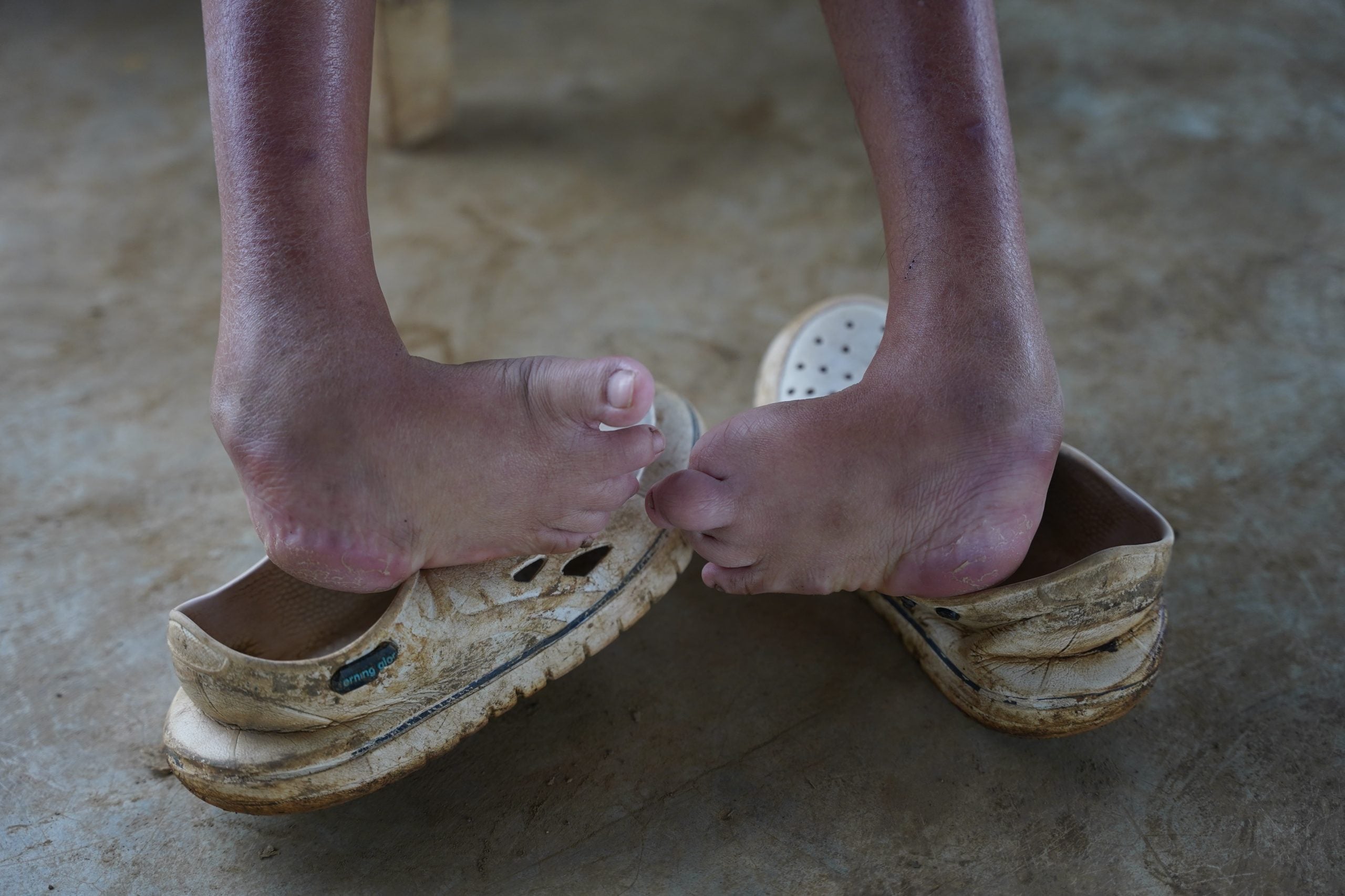 Closeup of Gliesas feet before the operation