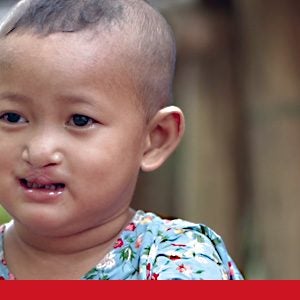 Die kleine Nant Myo Thazin aus Myanmar hat in ihren ersten Lebensjahren viel durchgemacht. Aufgrund ihrer Lippen- und Gaumenspalte konnte sie weder gestillt werden noch konnte sie später feste Nahrung zu sich nehmen. Die einzige Möglichkeit, die ihre Mutter für eine lebenserhaltende Ernährung sah, war, sie mit Kondensmilch zu füttern, da für hochwertigere Nahrung kein Geld zur Verfügung stand. Die Folge war eine bedenkliche Mangelernährung. Während gesunde zweijährige Kinder die Welt entdecken, kämpfte Nant Myo mit Krankheiten. Sie konnte weder sprechen lernen noch konnten sich ihre Zähne gesund entwickeln. Die langfristigen Folgen für ihre Entwicklung sind fatal. Eine Fehlbildung wie diese wird in Deutschland spätestens im 10. Lebensmonat behandelt.

Durch das geringe und unregelmäßige Einkommen der Eltern konnte dieser Eingriff nicht früher durchgeführt werden. Im Gegenteil waren die Eltern zeitweise so überarbeitet, dass die 11-jährige Schwester sich um die Versorgung des Mädchens kümmern musste.

Durch die freundliche Gabe eines Operation Blessing Spenders konnte die Lippen- und Gaumenspalte chirurgisch korrigiert werden. Teil der Behandlung war eine vorangehende Untersuchung, Beratung und schlussendlich die Operation und Nachbehandlung.

Die Eltern sind unendlich erleichtert, dass Nant Myo nun Nahrung zu sich nehmen kann, ohne sie umgehend wieder auszuspeien. Was die Operation für diesen jungen Menschen bedeutet, ist auf lange Sicht unbezahlbar. Nant Myo muss nun vieles aufholen, aber sie ist endlich in der Lage, die Welt zu entdecken und am Leben teilzunehmen, wie es für ein Mädchen ihres Alters angemessen ist.